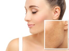 Des astuces naturelles pour faire disparaitre les taches brunes ou les taches de vieillissement sur votre peau