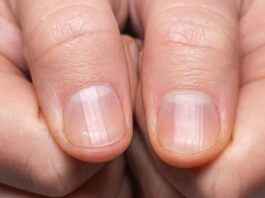 Est-il possible de remédier aux stries sur mes ongles ? Quelles en sont les causes ?